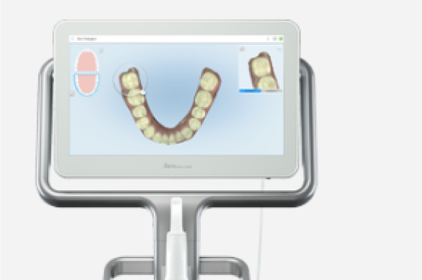 デジタルデータによる精密治療を実現した口腔内スキャナー「iTero」
