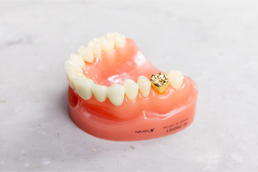 詰め物・被せ物についてもお口の状態や要望に合わせた治療方法をご提案